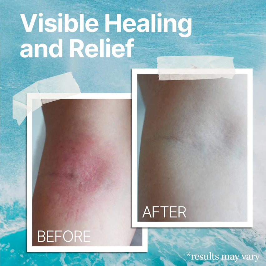 Eczema Relief Cream